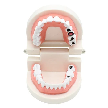 Модел на Кариес на Зъболекар за Обучение на зъбния Кариес Модел на Зъба се Грижат За Зъбите Модел Стоматологично Изследване на Лабораторен Материал Инструмент